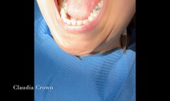 TAMARA'S AMALGAM - REMOVAL AND FILLING