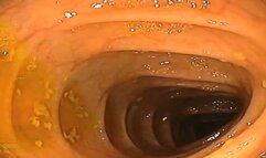 In the medical center for my first double endoscopy of the stomach and intestines 720HD