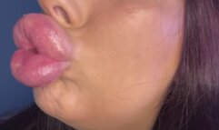 Showing off my freshly filled lips