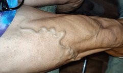 Tempest post surgery