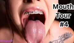 Braces Mouth Tour 4