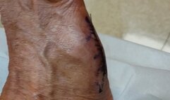 Tempest showing foot after cast removed