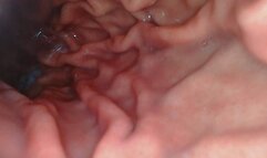 Sloane Reverse Endoscope Test