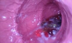 Bailey's Stomach Full of Gummy Bears