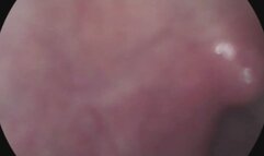 vore- gummy worm and endoscope