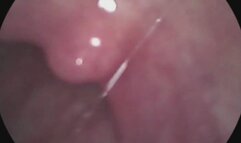 vore endoscope- lollipop!!!