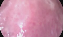 Endoscope- uvula, throat, mouth