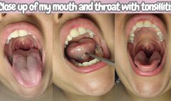 Close up of my mouth and throat with tonsillitis