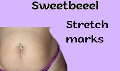 Stretch marks