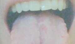 Bad breath and coated tongue!