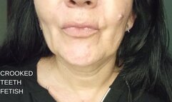 Crooked teeth fetish
