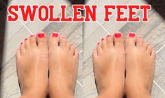 Swollen feet