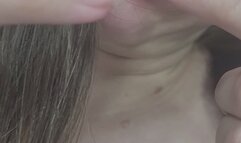 removing acne from my face and ears