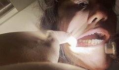 See my oral fistula and help me get a root canal soon (July 25 2025)