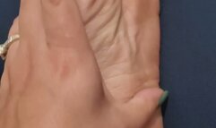 Dry soles need attention