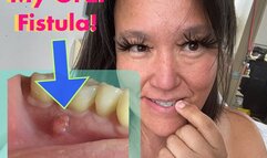 ROOT CANAL Tooth #46: I show you my Endodontics Referral Form. I did not know how teeth were counted! (oct 6 2025)