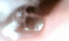 cherry tomatos endo stomach cam