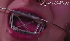 Metal Attraction: The art of a perfect smile.