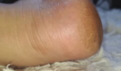 the imperfections of my feet