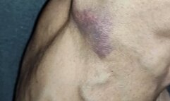 Tempest showing bruise