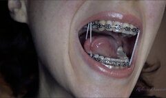 Fixed braces with elastic bands