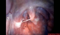 Big phlegm ENDOSCOPY