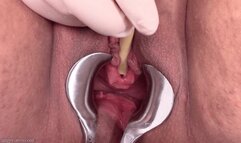 catheter floods my cunt with piss (720 wmv)