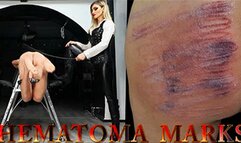 HEMATOMA MARKS mobile version