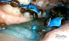 Reverse ASRM chewing view