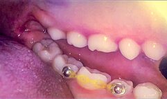 Endoscope: My First Mouth Adventure (Part 2)