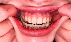 Teeth Examination 1080p