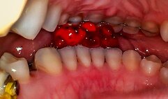 Reverse Gummy Bear Vore 2