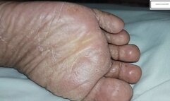 Delicious Athletes Foot inspection upclose