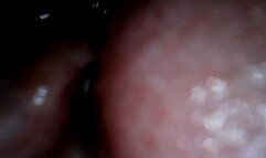 swallowing toy attached to endoscope