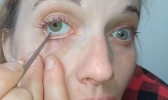 Emergency surgery on my eyes