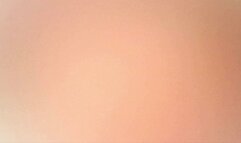 stomach endo twizzler in stomach