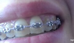 Teeth with brazers to cam mp4