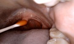 uvula cholula: direct hot sauce application with swab (720 mp4)