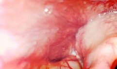 Down my throat - New extreme exploration with the Pillcam 1080HD