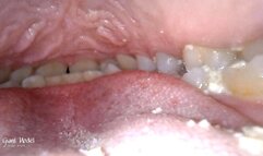 Inside a man's mouth during the lunch