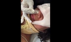 Naso Gastric Feeding Tube Insertion