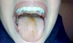 my tongue and uvula