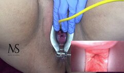 injecting coke cola into my uterus