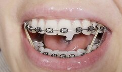 EPIC handjob with cum on BRACES and elastics!