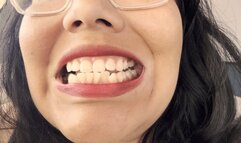 Teeth tour before deep cleaning