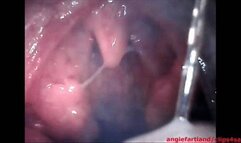 Tonsillitis mouth tour wmv