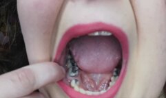 Silver filling mouth tour
