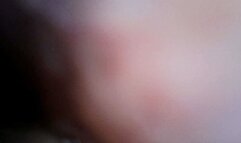 noodles inside stomach endoscope