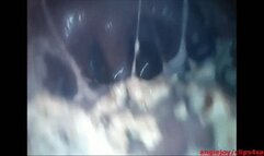 Endoscopy while crushing food wmv