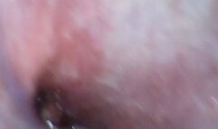 stomach endoscope with noodles